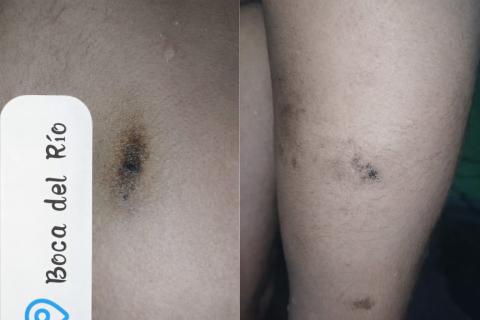 Denuncian daños a la salud por contacto con crudo en Boca del Río