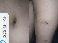 Denuncian daños a la salud por contacto con crudo en Boca del Río