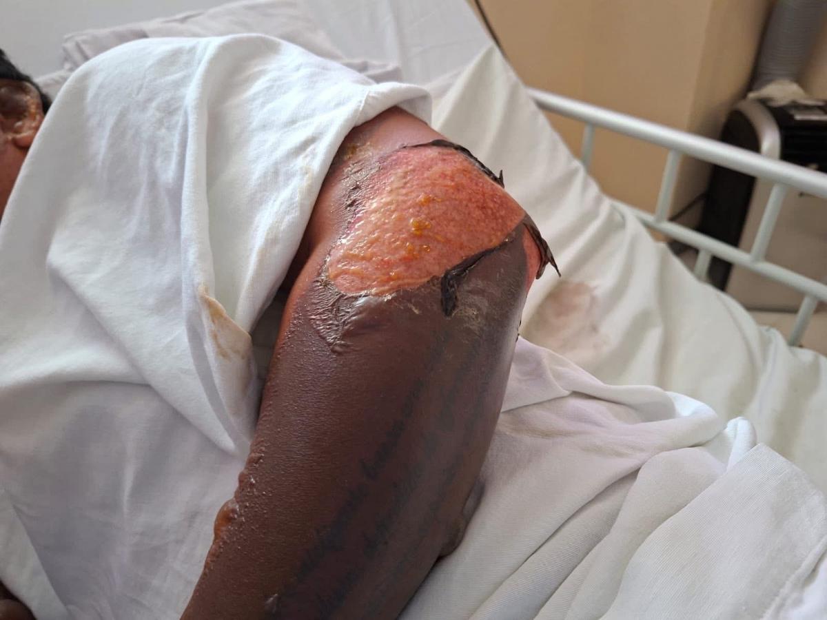 trabajador_herido-explosion-boca_del_rio.jpg