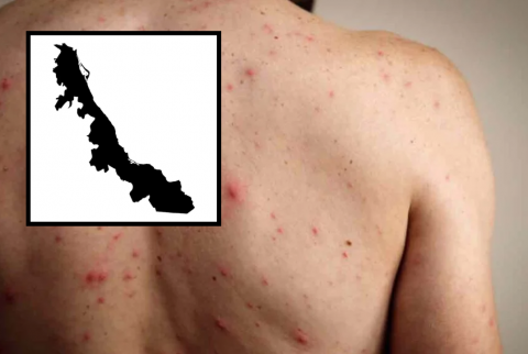 Brote de sarampión va en aumento: Veracruz suma 24 casos confirmados Brote de sarampión va en aumento: Veracruz suma 24 casos confirmados