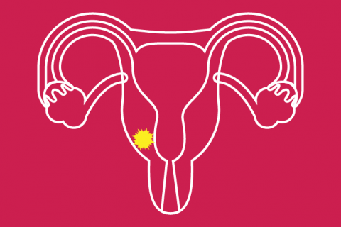 Ahora dejan sin presupuesto a programa contra cáncer cervicouterino