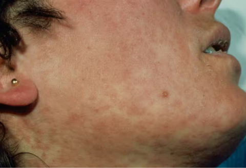 Primera muerte de sarampión en México, reanudarán campaña de vacunas