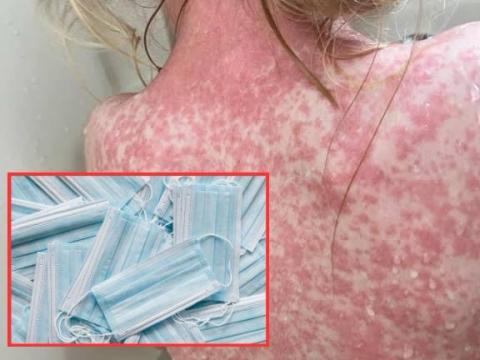 Veracruz suma 21 casos de sarampión; escuelas piden usar cubrebocas